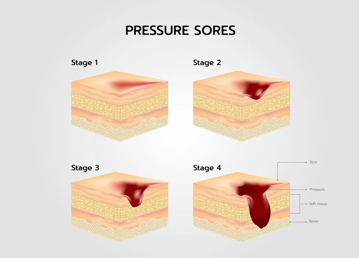 Piaghe da decubito: cosa sono e come prevenirle